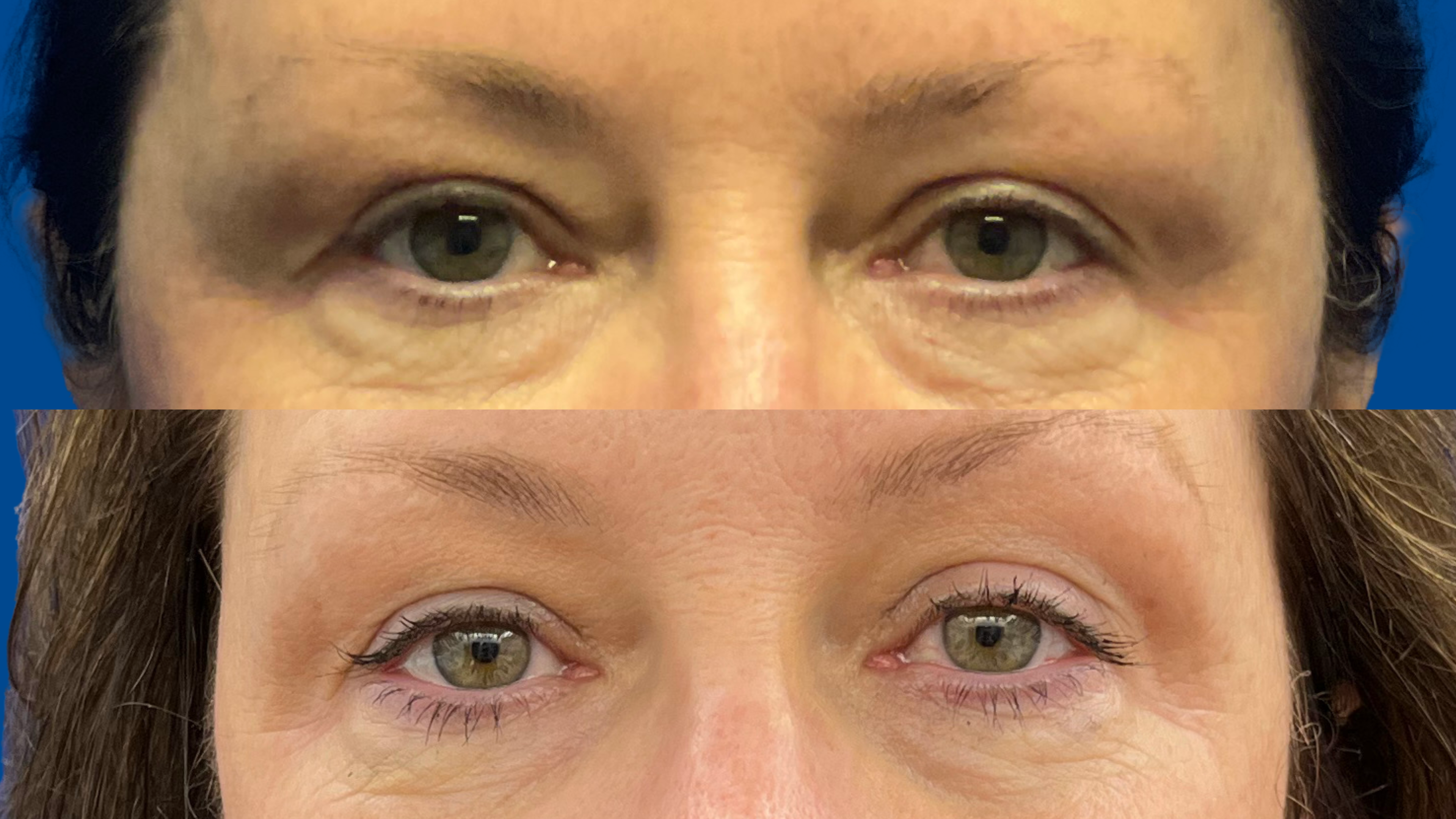 Proceduri Morpheus 8