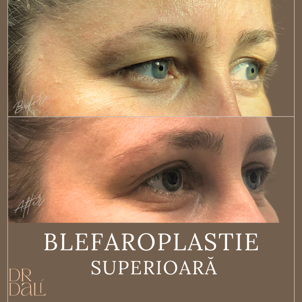 Blefaroplastie