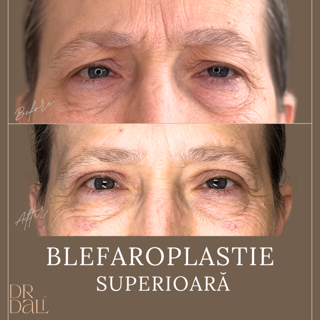 Blefaroplastie