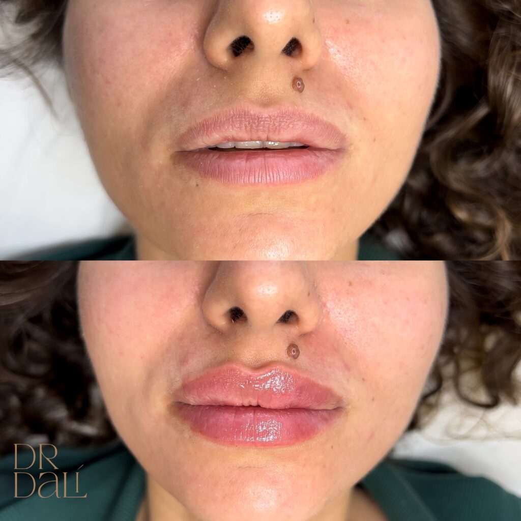 Mărire buze cu acid hialuronic