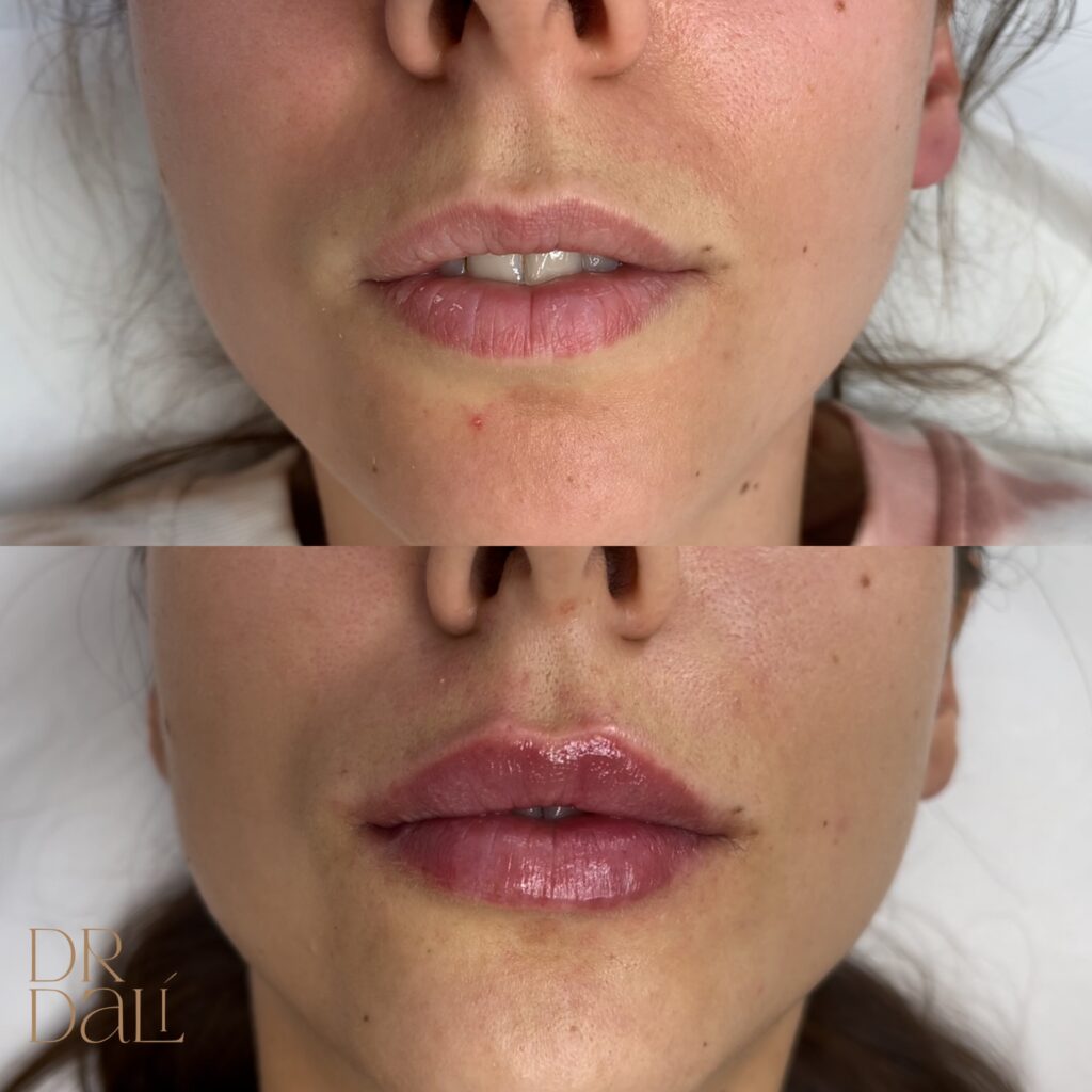 Mărire buze cu acid hialuronic