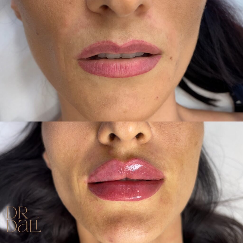 Mărire buze cu acid hialuronic