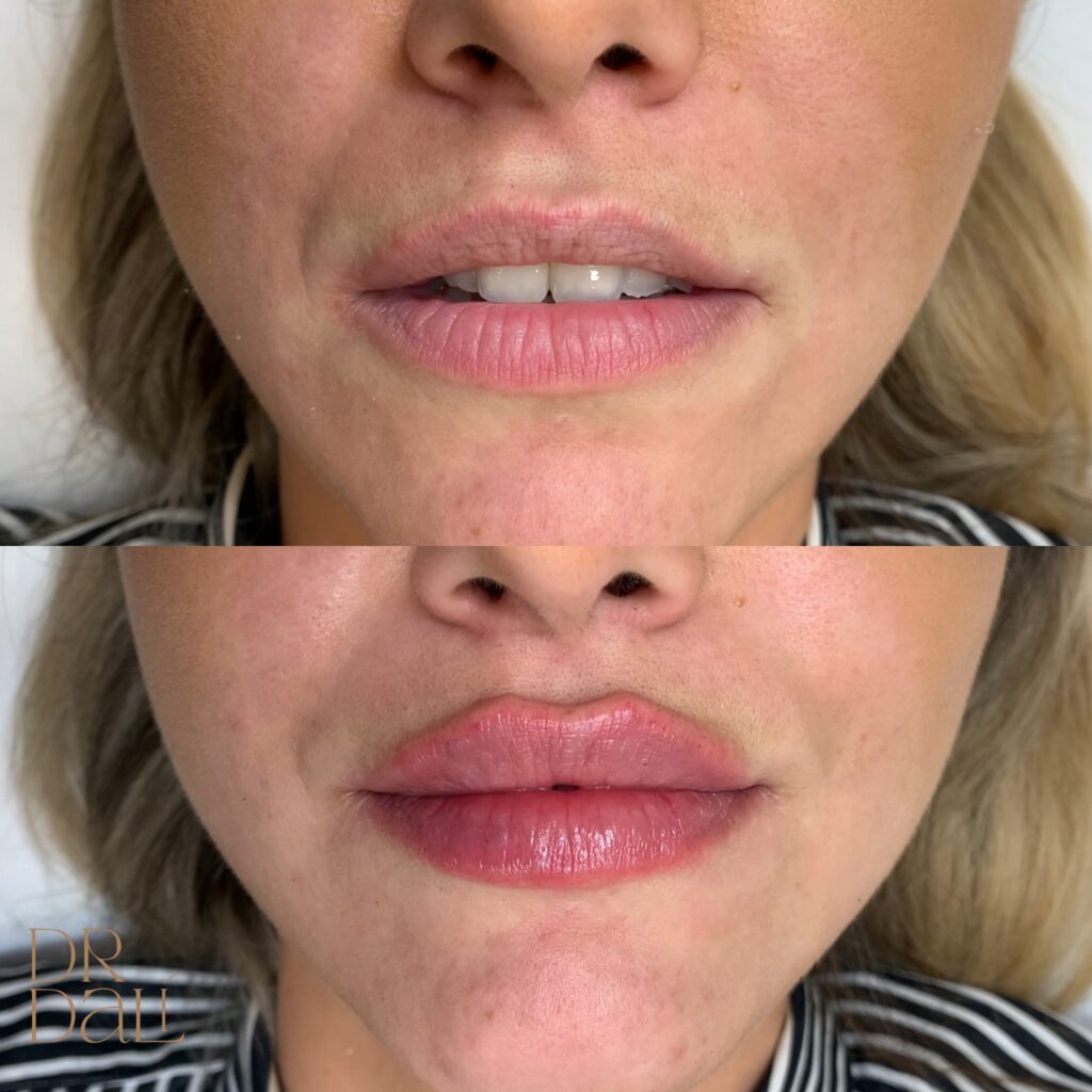 Mărire buze cu acid hialuronic