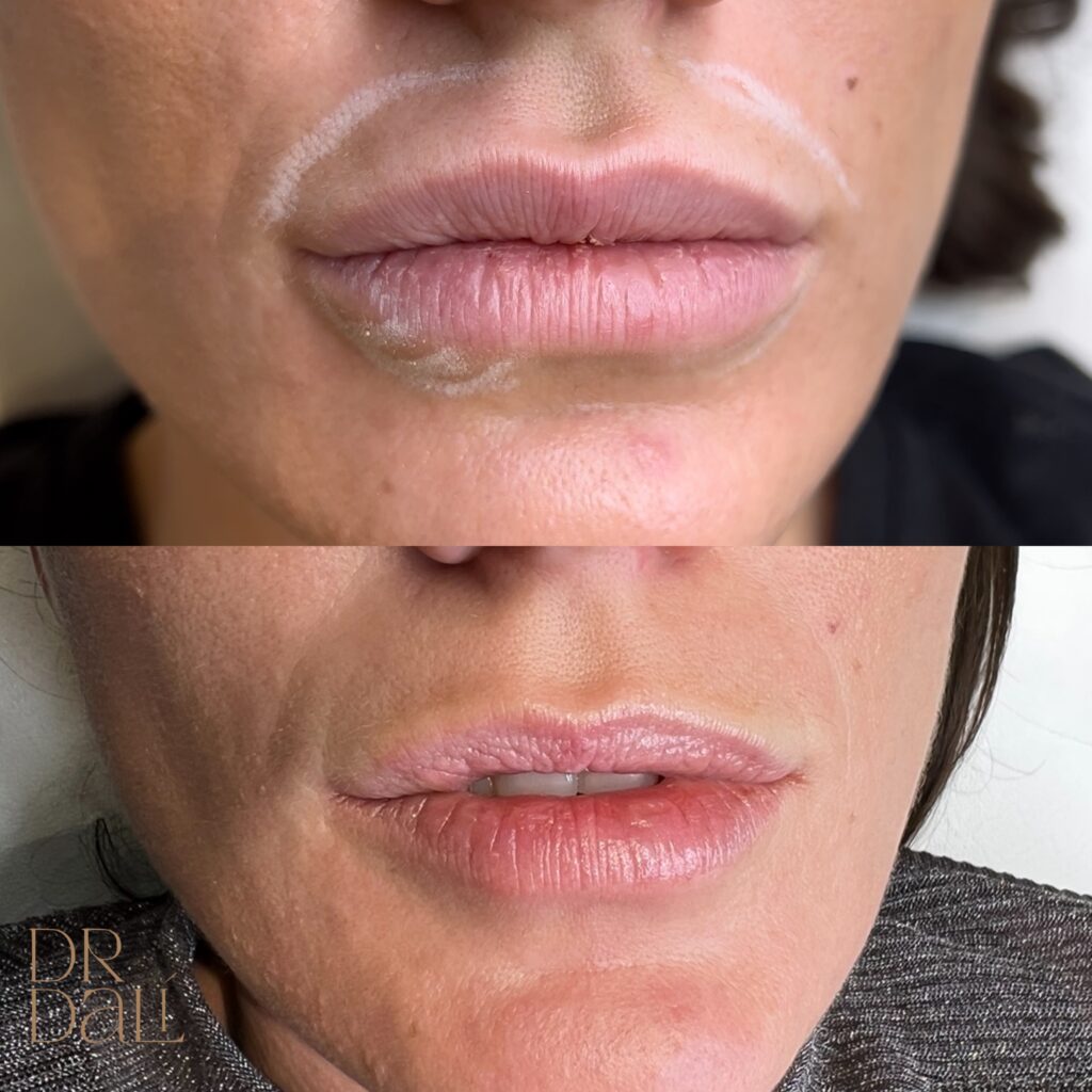 Topire acid hialuronic